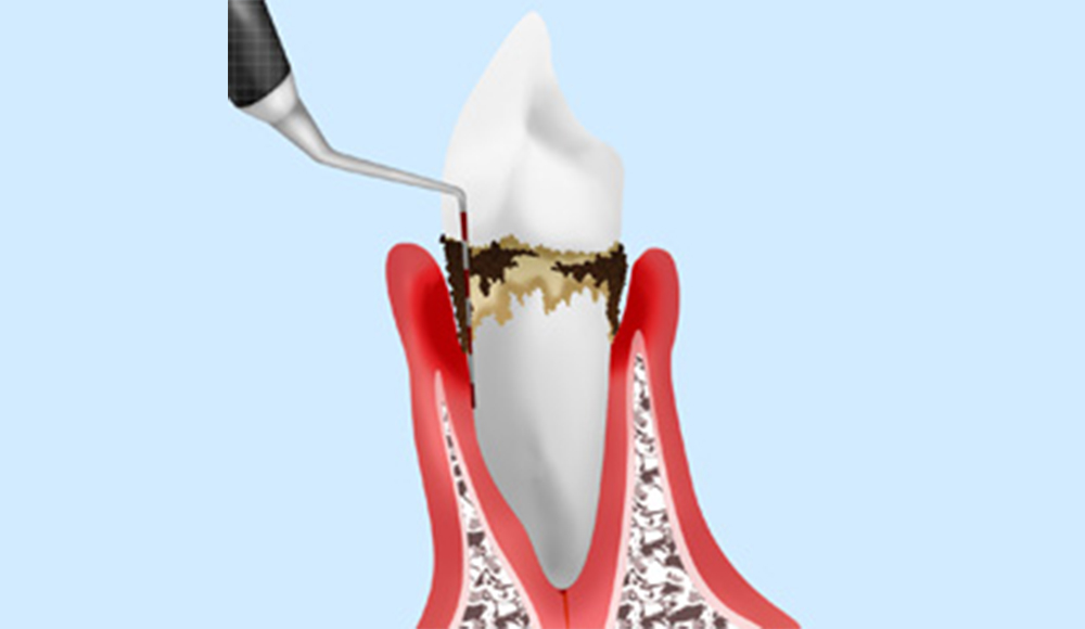 歯周病の精密検査